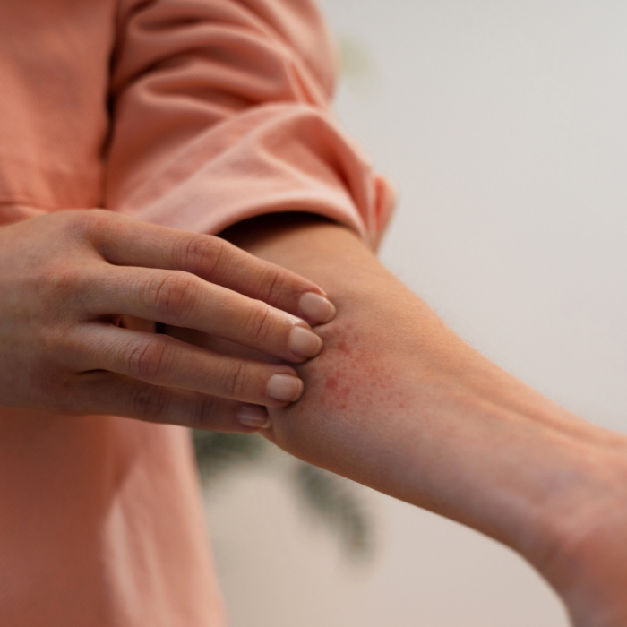 Alérgenos alimentarios