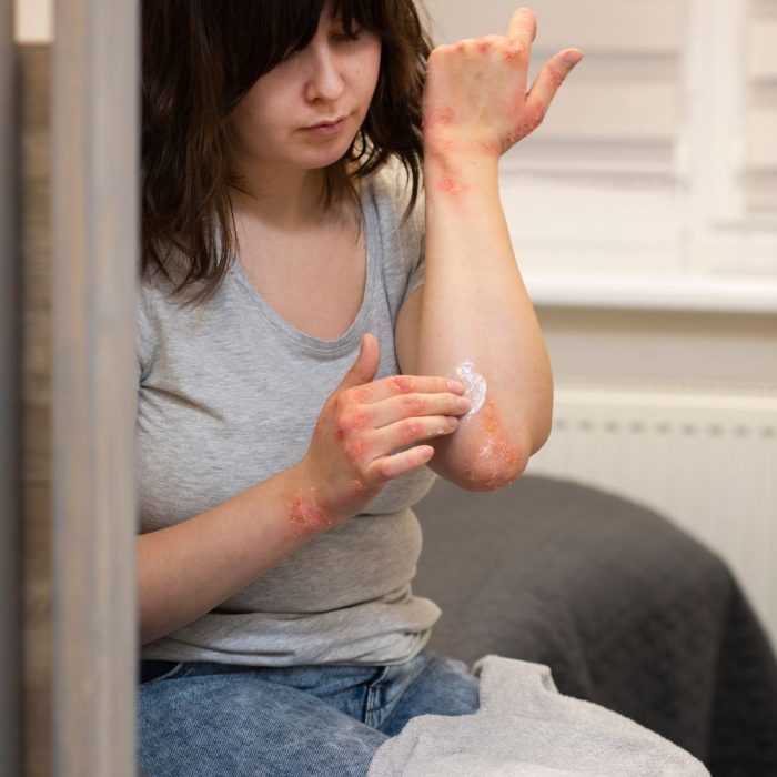 Alérgenos alimentarios+respiratorios